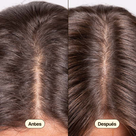 Hair Growth & Density Treatament